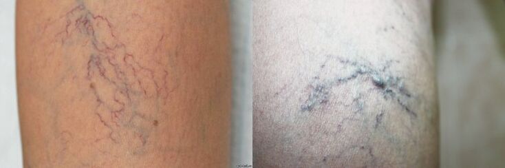 Síntomas de las venas varicosas