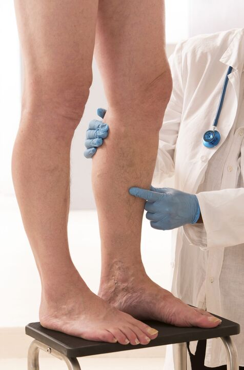 Varicosis que es