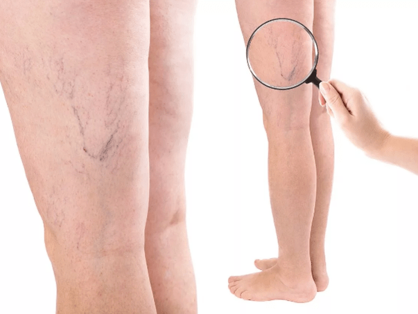 Venas varicosas en mujeres