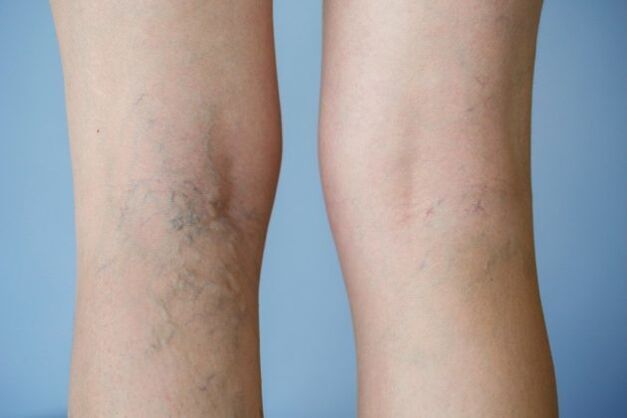 varices
