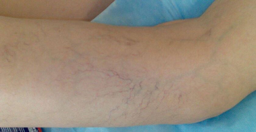 Estrellas vasculares en las piernas