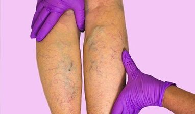 ¿Qué se puede y no se puede hacer con venas varicosas
