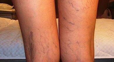 Cómo tratar la expansión de la varicona en las mujeres en las mujeres