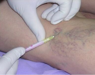 inyecciones para venas varicosas