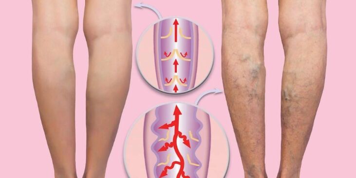venas sanas y varicosas en la pierna